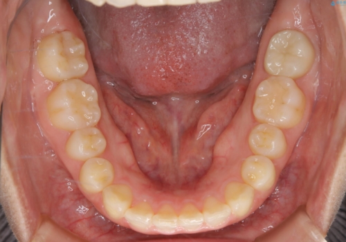 前歯のねじれと深い噛み合わせの改善:インビザライン治療の治療後
