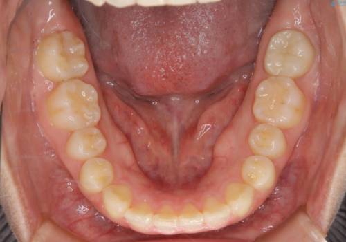前歯のねじれと深い噛み合わせの改善:インビザライン治療の治療後
