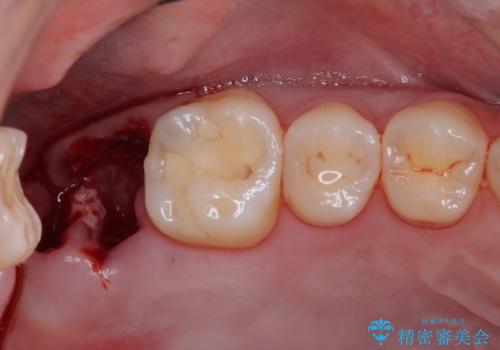 歯医者が怖い 1DAYインプラントで外科処置の恐怖を軽減の治療中