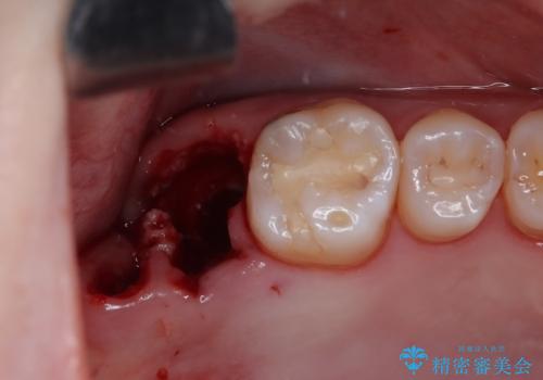 歯医者が怖い 1DAYインプラントで外科処置の恐怖を軽減の治療前