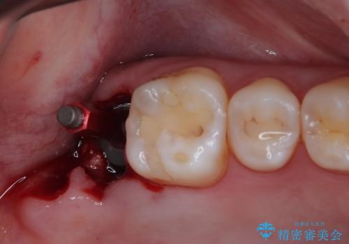歯医者が怖い 1DAYインプラントで外科処置の恐怖を軽減の治療中