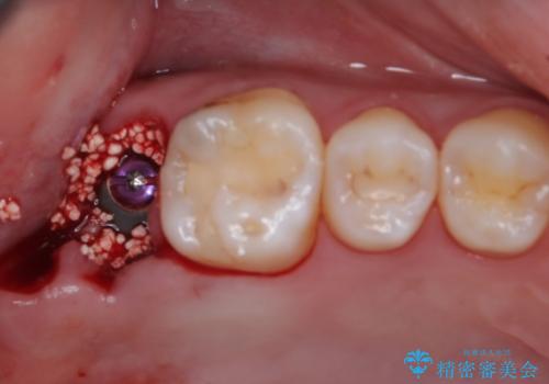 歯医者が怖い 1DAYインプラントで外科処置の恐怖を軽減の治療後