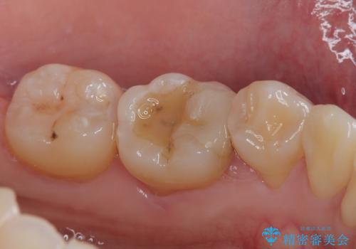 保険の白い詰め物が割れた ハイブリッドインレーの治療前