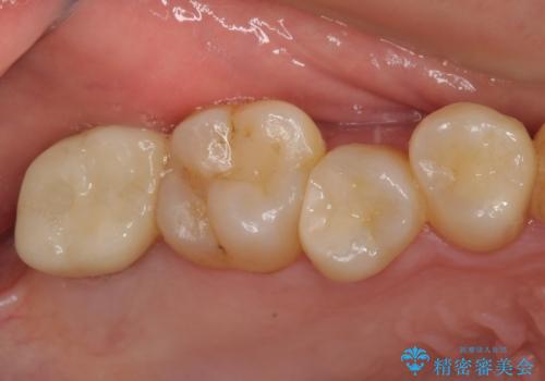 放置したむし歯　抜歯後にインプラントで補綴治療の症例 治療後