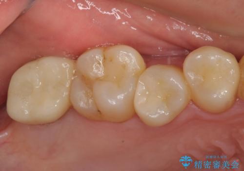 放置したむし歯 抜歯後にインプラントで補綴治療の症例 治療後