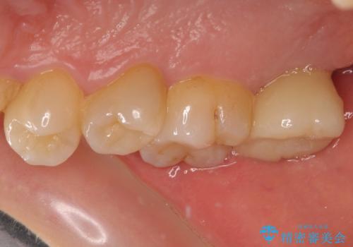 放置したむし歯 抜歯後にインプラントで補綴治療の治療後