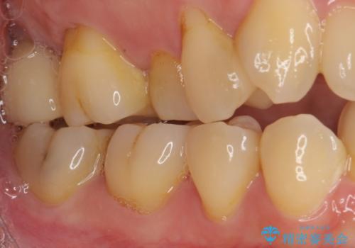 放置したむし歯　抜歯後にインプラントで補綴治療の治療後