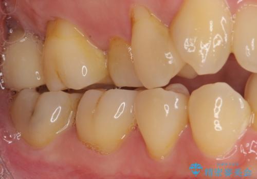 放置したむし歯 抜歯後にインプラントで補綴治療の治療後