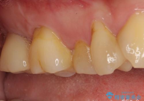 放置したむし歯 抜歯後にインプラントで補綴治療の治療後