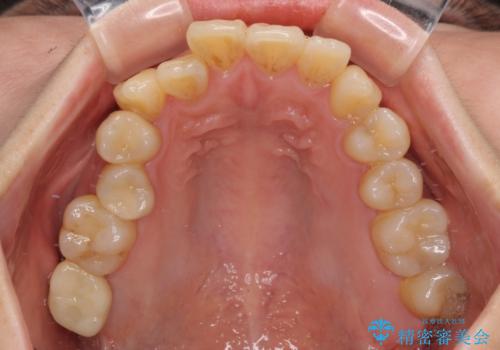 放置したむし歯 抜歯後にインプラントで補綴治療の治療後