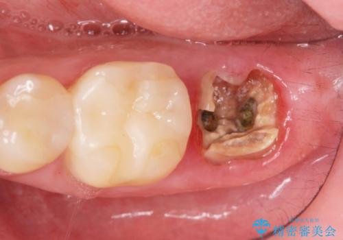 歯からの異臭　虫歯の再発からのインプラント治療の治療前