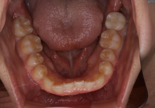 前歯のねじれと深い噛み合わせの改善:インビザライン治療の治療前
