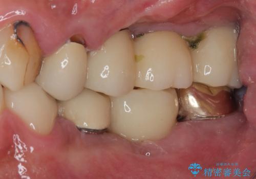 割れてしまった奥歯を1DAYインプラントで短期間治療の治療後