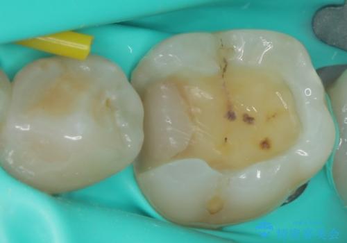 保険の白い詰め物が割れた ハイブリッドインレーの治療中