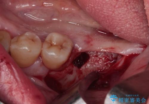 治療中で放置 インプラントでしっかりと咬めるようにの治療前