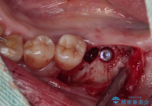 治療中で放置 インプラントでしっかりと咬めるようにの治療中