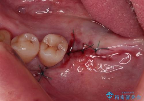 治療中で放置 インプラントでしっかりと咬めるようにの治療後