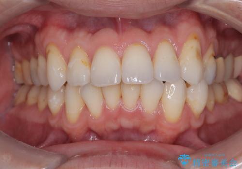 銀歯をなくしたい 全顎的なむし歯治療の症例 治療後