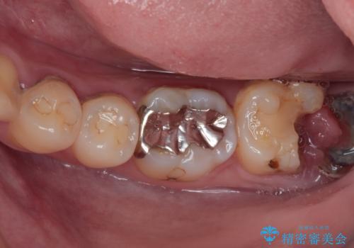 歯医者が怖い 1DAYインプラントで外科処置の恐怖を軽減の治療前