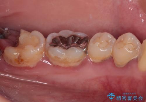 歯医者が怖い 1DAYインプラントで外科処置の恐怖を軽減の治療前