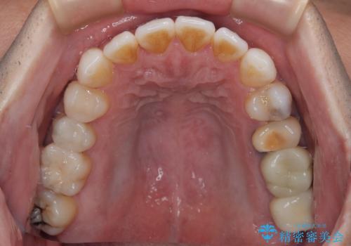 銀歯をなくしたい　全顎的なむし歯治療の治療後