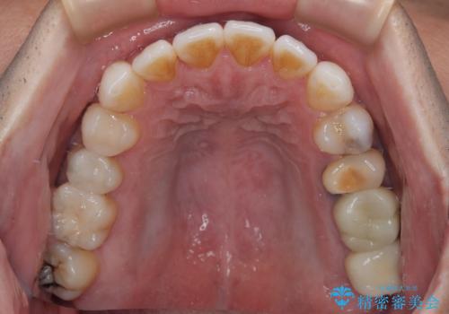 銀歯をなくしたい 全顎的なむし歯治療の治療後