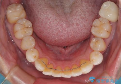 銀歯をなくしたい 全顎的なむし歯治療の治療後