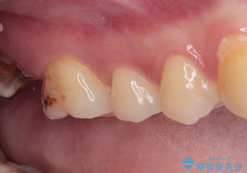 歯医者が怖い 1DAYインプラントで外科処置の恐怖を軽減の治療前