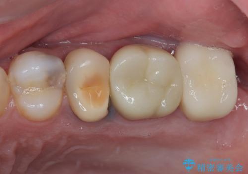 銀歯をなくしたい 全顎的なむし歯治療の治療後