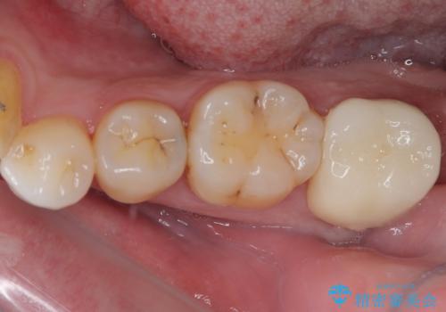 銀歯をなくしたい　全顎的なむし歯治療の治療後