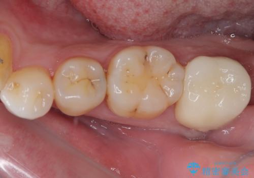 銀歯をなくしたい 全顎的なむし歯治療の治療後