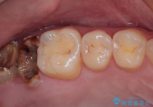 歯医者が怖い 1DAYインプラントで外科処置の恐怖を軽減の症例 治療前