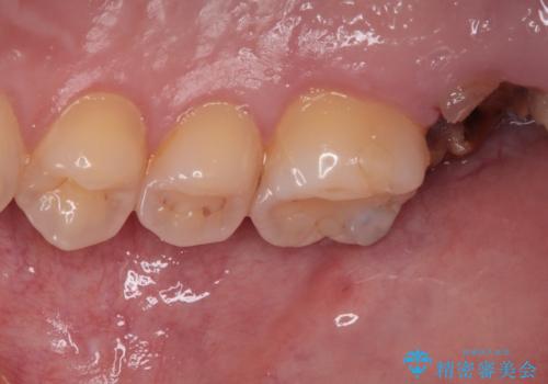 歯医者が怖い 1DAYインプラントで外科処置の恐怖を軽減の治療前