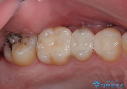 銀歯をなくしたい　全顎的なむし歯治療の治療後