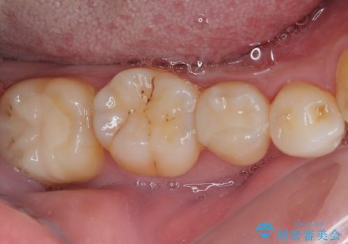 銀歯をなくしたい　全顎的なむし歯治療の治療後