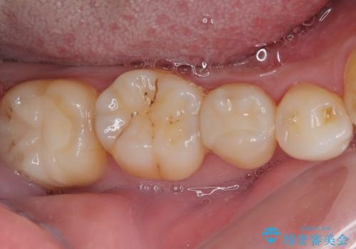 銀歯をなくしたい 全顎的なむし歯治療の治療後