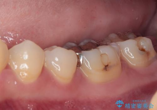 歯医者が怖い 1DAYインプラントで外科処置の恐怖を軽減の治療前