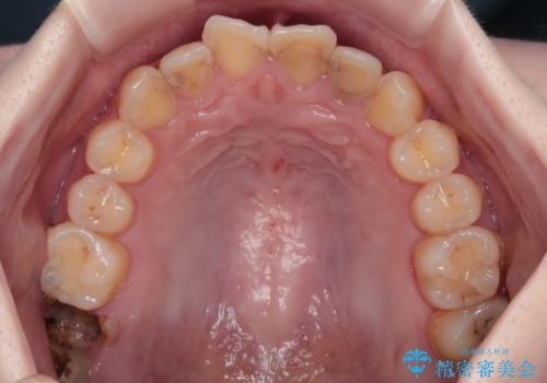 歯医者が怖い 1DAYインプラントで外科処置の恐怖を軽減の治療前