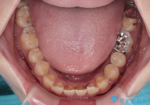 歯医者が怖い 1DAYインプラントで外科処置の恐怖を軽減の治療前