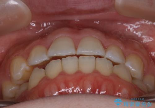 【非抜歯】上下の前歯が噛み合わないオープンバイトの治療の治療後