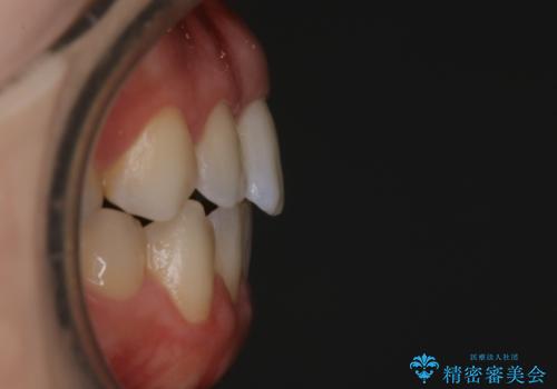 【非抜歯】上下の前歯が噛み合わないオープンバイトの治療の治療後