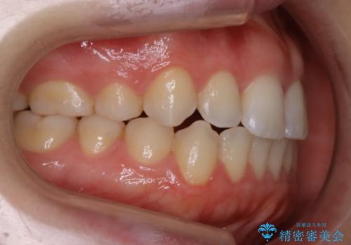 【非抜歯】上下の前歯が噛み合わないオープンバイトの治療の治療中