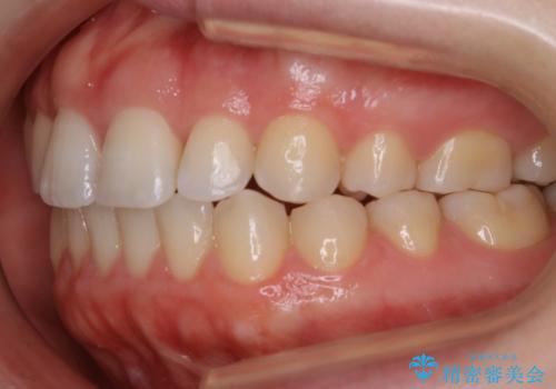 【非抜歯】上下の前歯が噛み合わないオープンバイトの治療の治療後