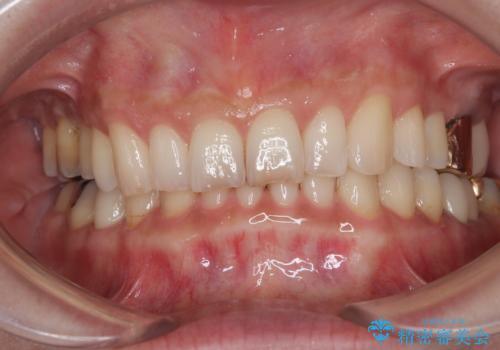 デコボコの歯とむし歯 インビザライン矯正治療とむし歯治療