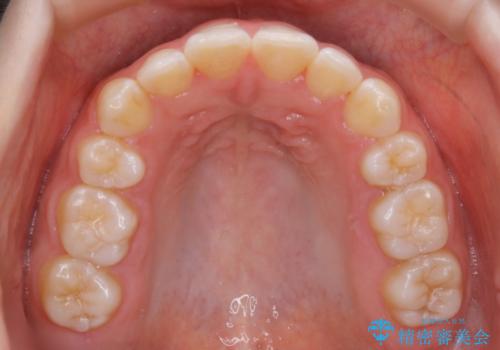 【非抜歯】前歯の上下が噛み合わないオープンバイトの治療の治療後