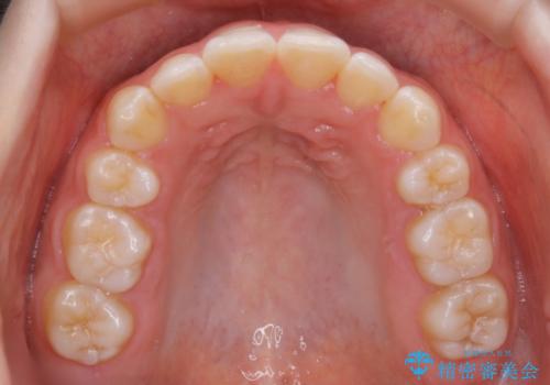 【非抜歯】上下の前歯が噛み合わないオープンバイトの治療の治療後