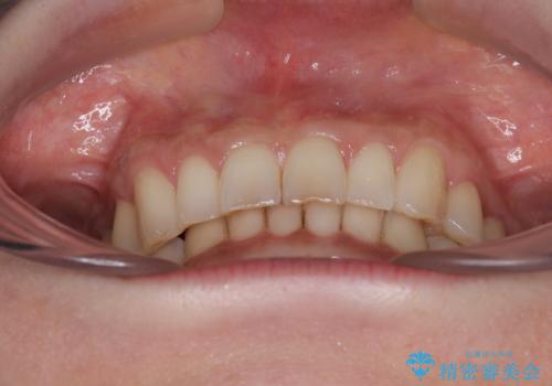 デコボコの歯とむし歯 インビザライン矯正治療とむし歯治療の治療後