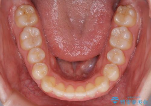 【非抜歯】上下の前歯が噛み合わないオープンバイトの治療の治療後