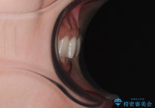 デコボコの歯とむし歯 インビザライン矯正治療とむし歯治療の治療後