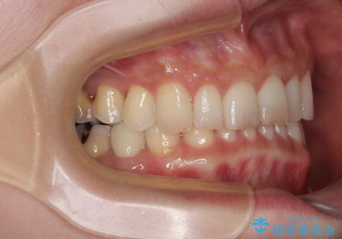 デコボコの歯とむし歯 インビザライン矯正治療とむし歯治療の治療後